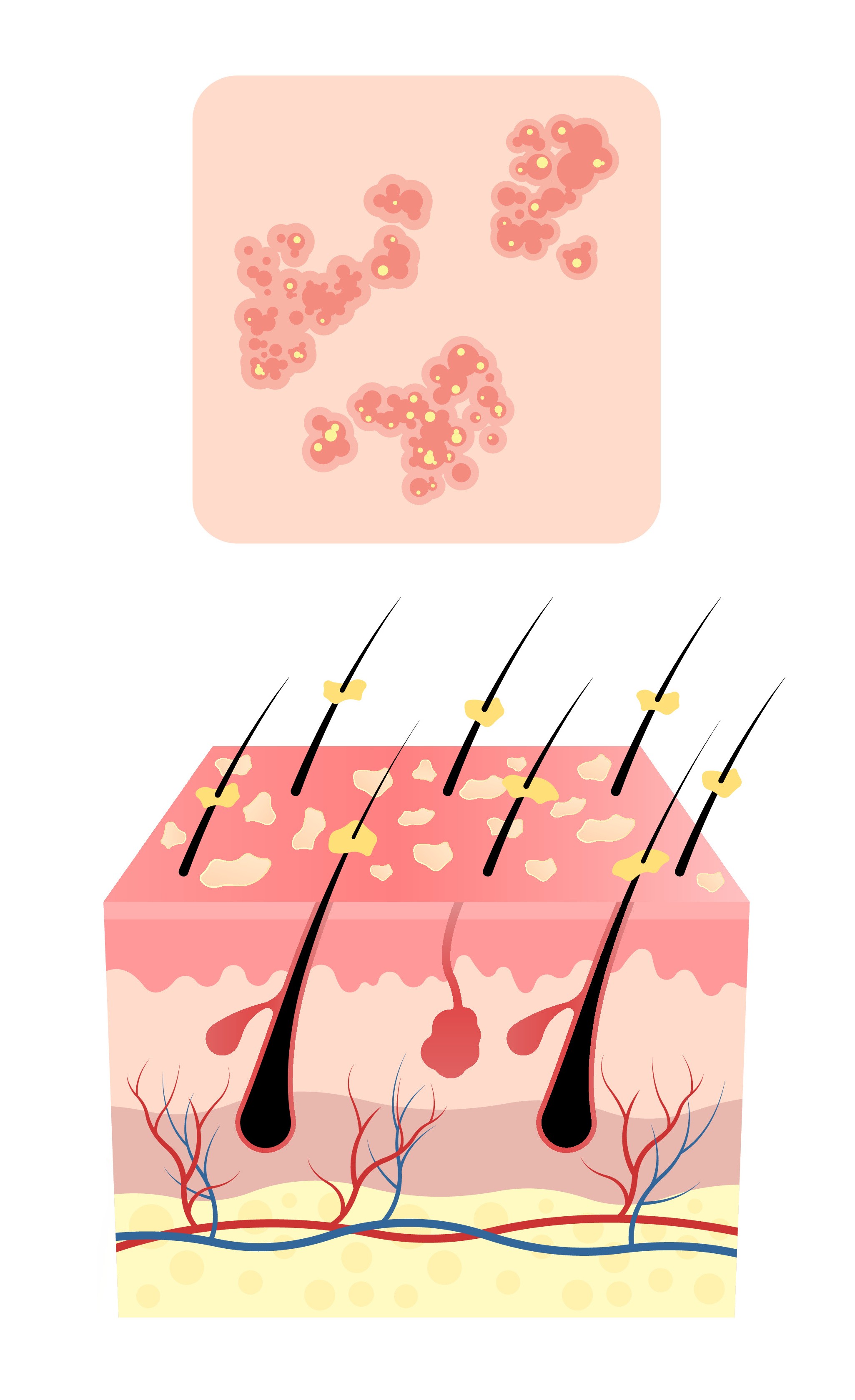 Comprendre le psoriasis du cuir chevelu